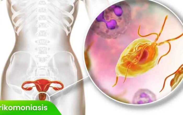 Trikomoniasis pada Pria dan Wanita: Gejala yang Perlu Diketahui