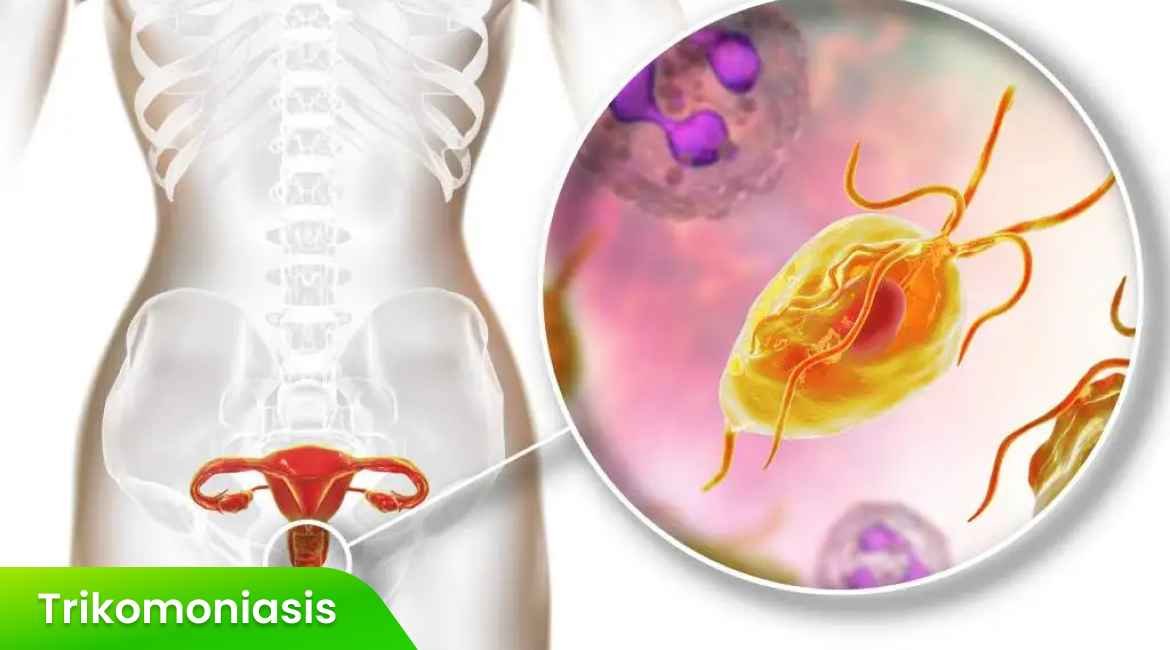 Trikomoniasis pada Pria dan Wanita: Gejala yang Perlu Diketahui