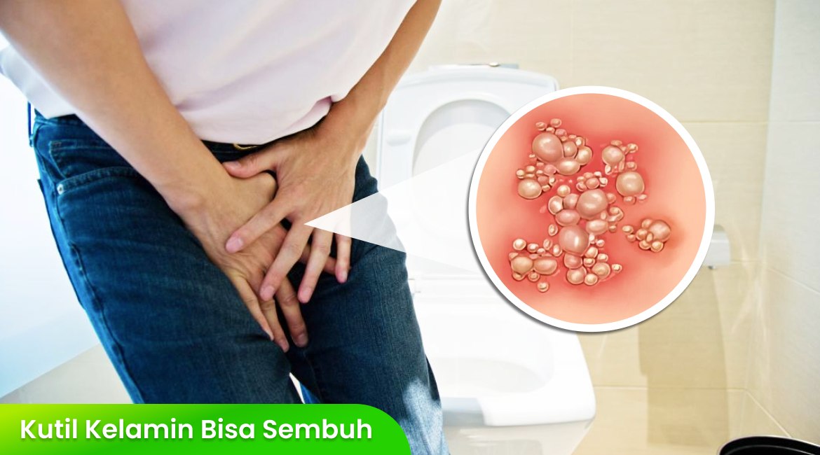 Apakah Kutil Kelamin Bisa Sembuh Tanpa Operasi?