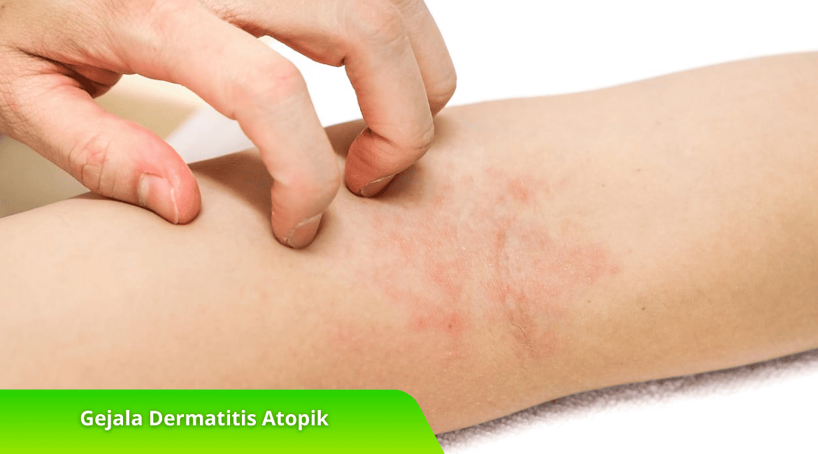 Mengenal Gejala Dermatitis Atopik dan Cara Penanganannya