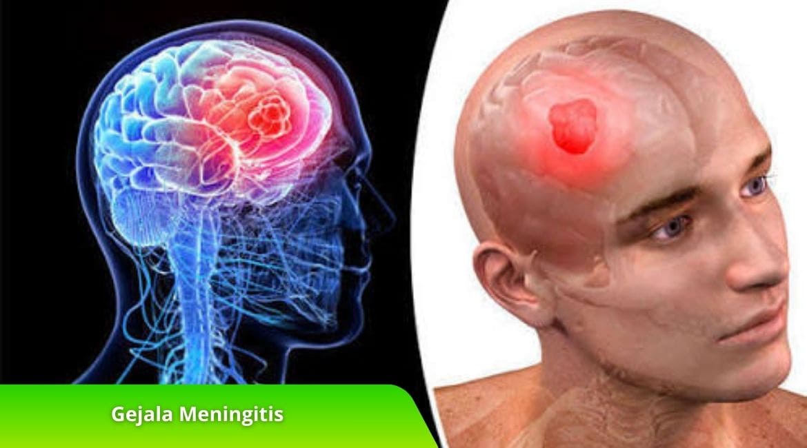 Gejala Meningitis dan Penanganan yang Tepat, Cari Tahu Disini!