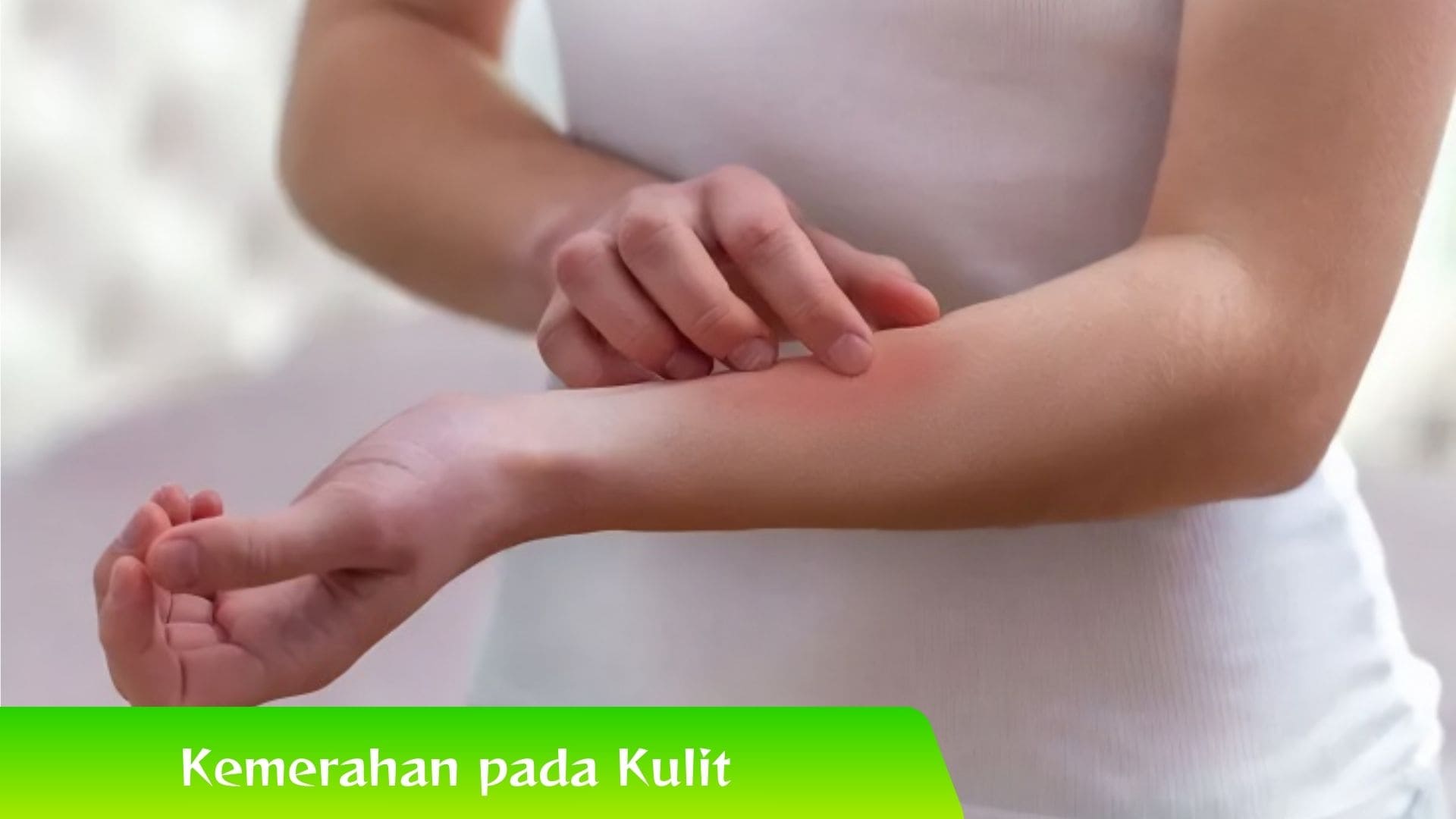 Hati-Hati! Kemerahan pada kulit bisa Jadi Tanda Dermatitis