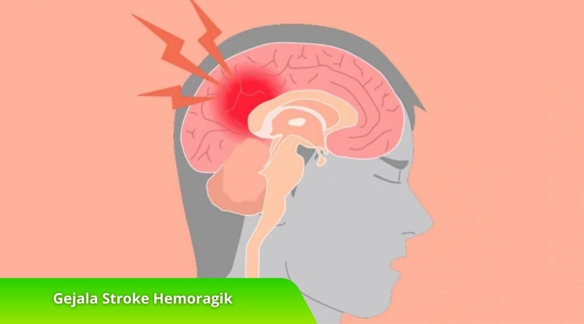 Kenali Gejala Stroke Hemoragik untuk Penanganan Cepat