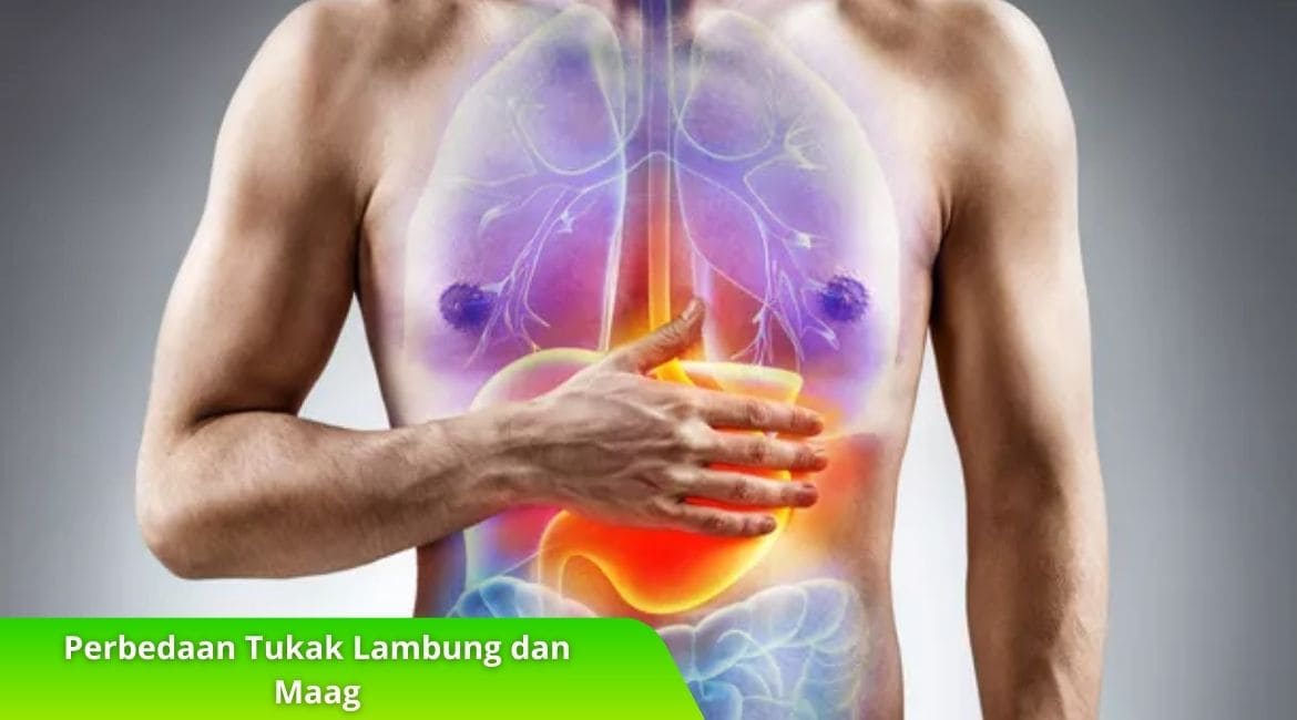 Memahami Perbedaan Tukak Lambung dan Maag, Intip Disini!