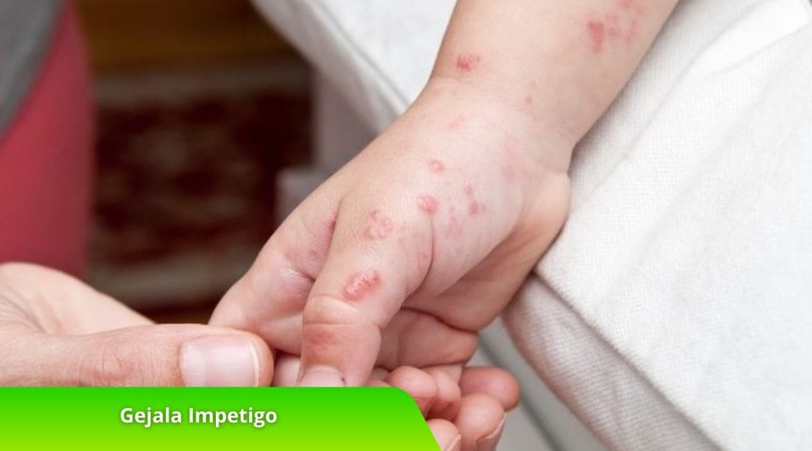 Mengenal Gejala Impetigo: Ciri-Ciri dan Cara Mengatasinya