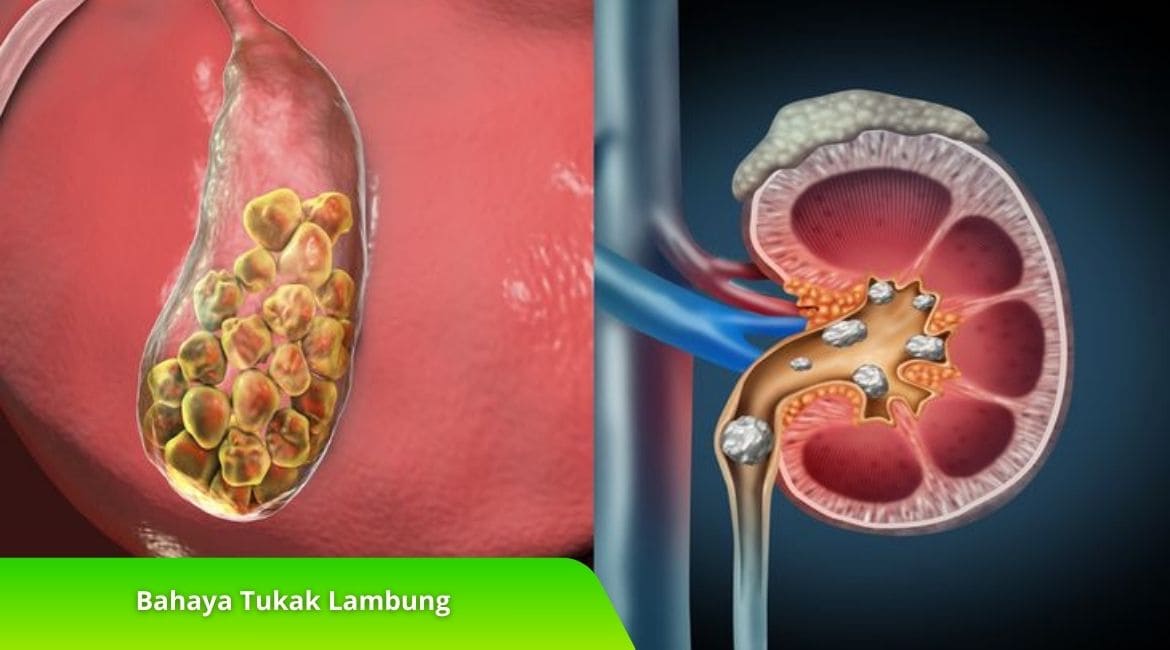 Bahaya Tukak Lambung dan Langkah Pencegahan Efektif Bahaya Tukak Lambung dan Langkah Pencegahan Efektif