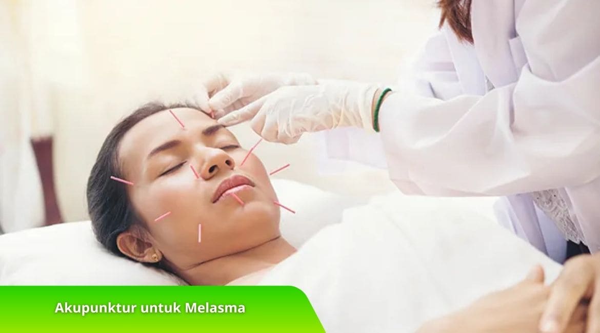 Efektivitas Akupunktur untuk Melasma, Cek di Sini! Efektivitas Akupunktur untuk Melasma, Cek di Sini!