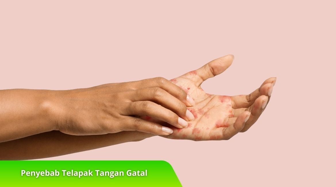 Penyebab Telapak Tangan Gatal dan Cara Mengatasinya