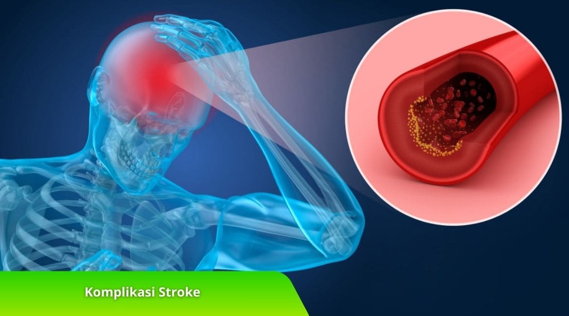 Waspada! Ini Komplikasi Stroke yang Paling Berbahaya Waspada! Ini Komplikasi Stroke yang Paling Berbahaya