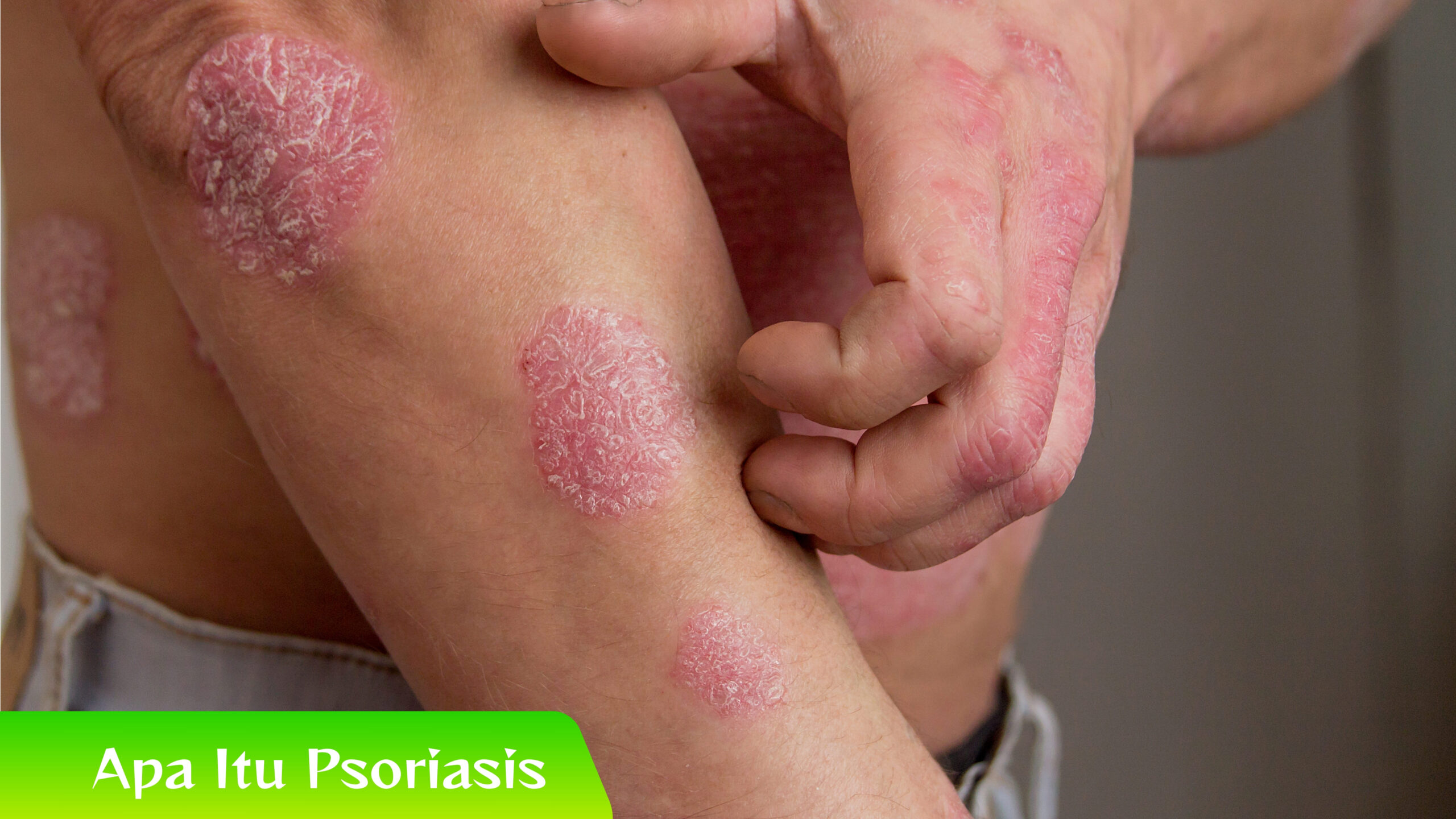 Apa Itu Psoriasis Apa Itu Psoriasis? Lebih dari Sekadar Masalah Kulit
