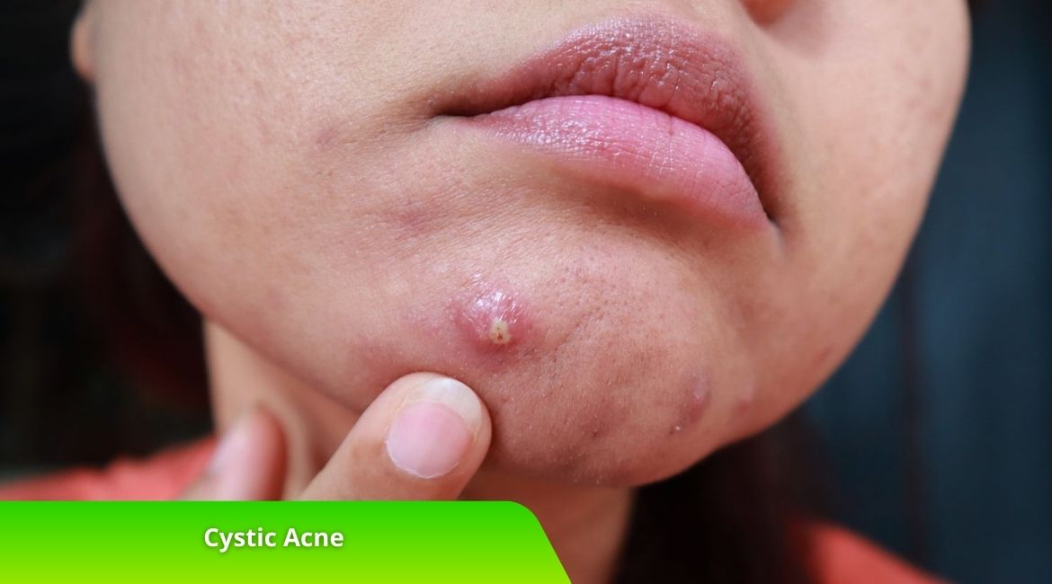 Cystic Acne: Penyebab, Gejala, dan Cara Mengatasinya