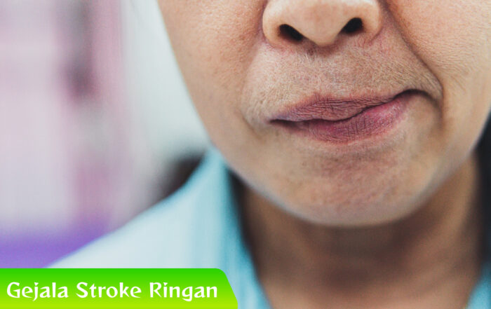 Waspadai 5 Gejala Stroke Ringan Ini Sebelum Terlambat
