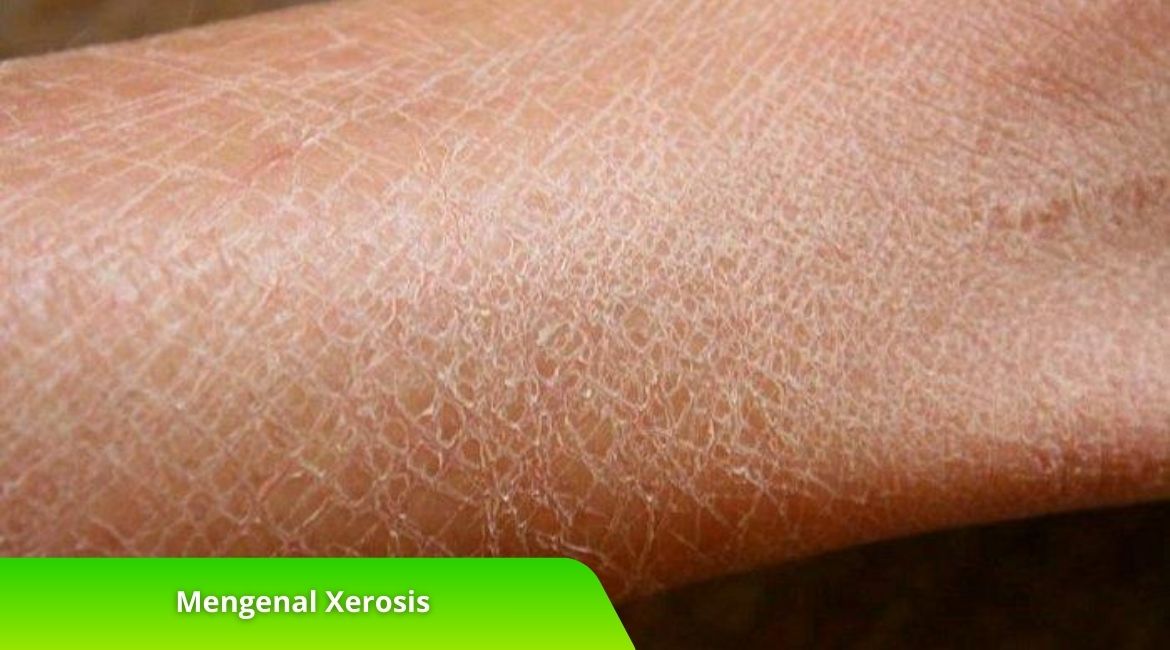 Mengenal Xerosis Lebih Dalam, Intip Sekarang! Mengenal Xerosis Lebih Dalam, Intip Sekarang!