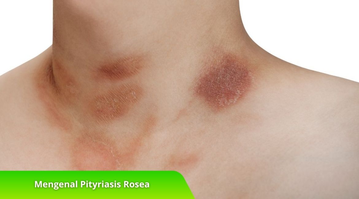 Mengenal Pityriasis Rosea dan Bedanya dengan Penyakit Kulit Lain Mengenal Pityriasis Rosea dan Bedanya dengan Penyakit Kulit Lain