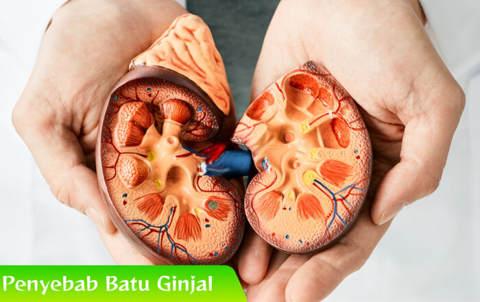 Apa Saja Penyebab Batu Ginjal? Ini Jawaban Medisnya
