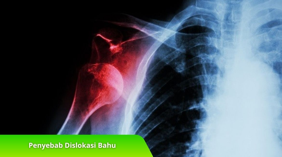 Penyebab Dislokasi Bahu dan Pertolongan Pertama yang Tepat Penyebab Dislokasi Bahu dan Pertolongan Pertama yang Tepat