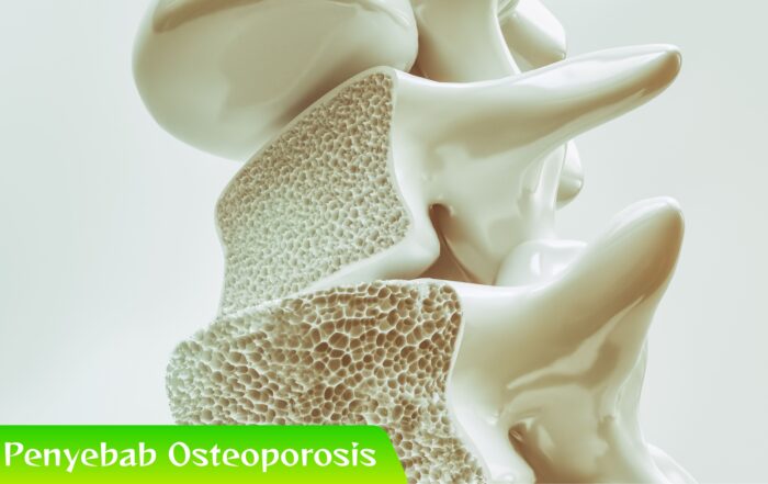 Makanan Sehari-hari yang Jadi Penyebab Osteoporosis