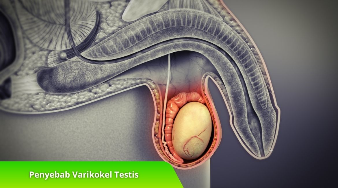 Penyebab Varikokel Testis dan Dampaknya pada Kesuburan Penyebab Varikokel Testis dan Dampaknya pada Kesuburan