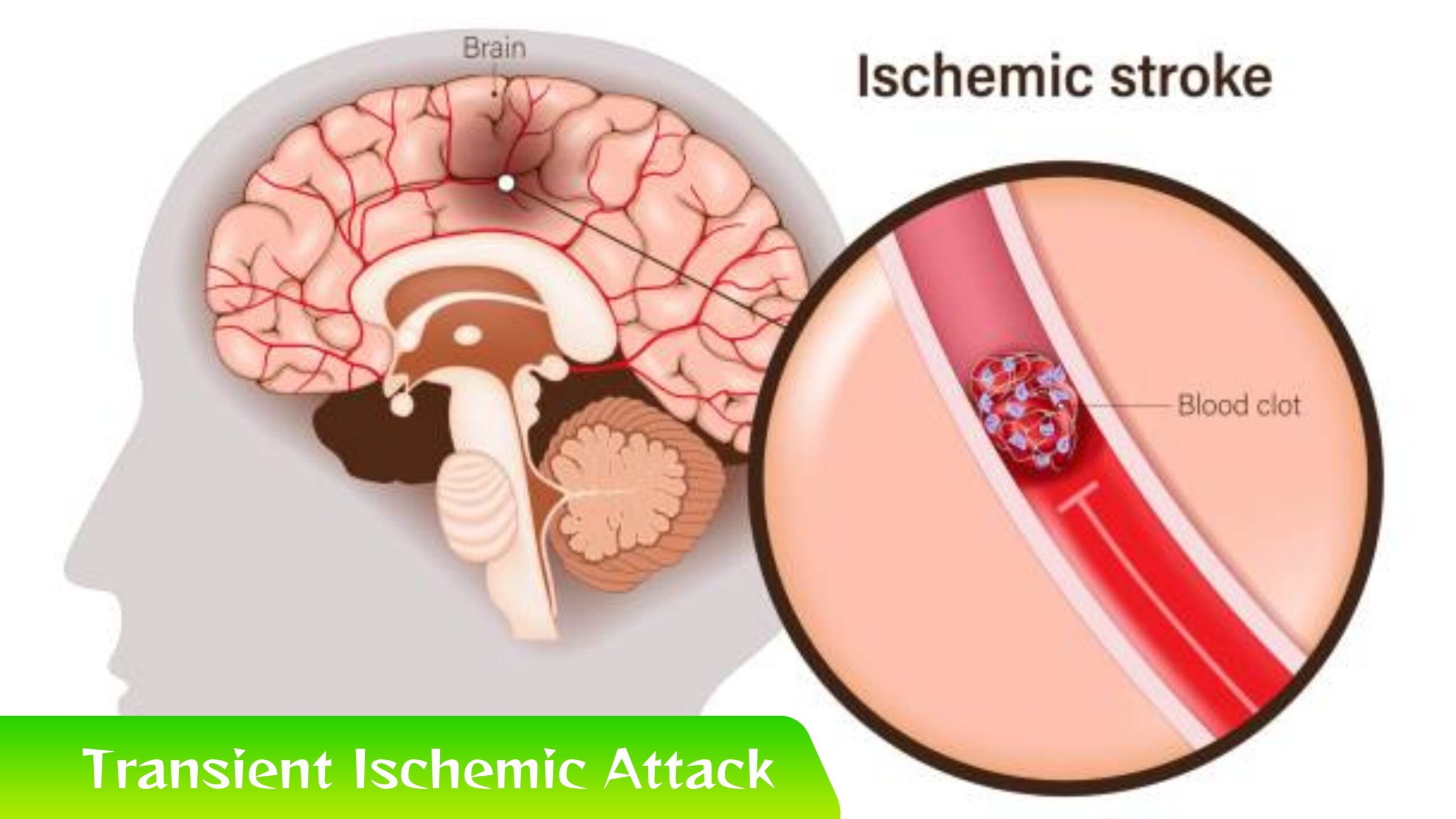 Transient Ischemic Attack: Sinyal Kecil Bahaya Besar