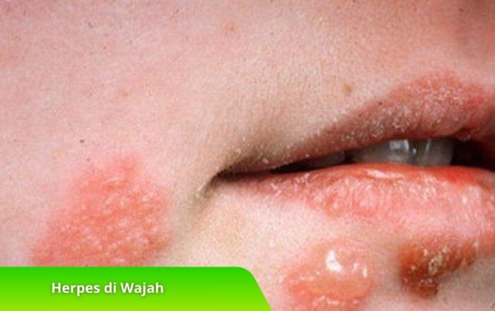 Waspada Herpes di Wajah! Kenali Ciri-Ciri dan Penanganannya