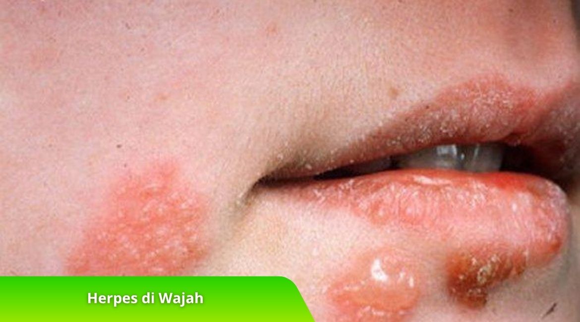 Waspada Herpes di Wajah! Kenali Ciri-Ciri dan Penanganannya Waspada Herpes di Wajah! Kenali Ciri-Ciri dan Penanganannya