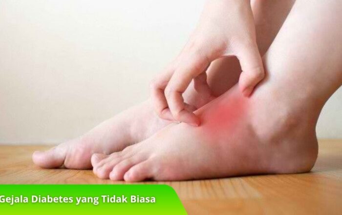 7 Gejala Diabetes yang Tidak Biasa, Apakah Anda Mengalaminya?
