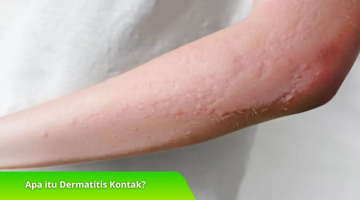 Apa itu Dermatitis Kontak? Ini Bedanya dengan Eksim Biasa