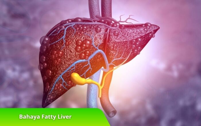 Bahaya Fatty Liver dan Cara Pencegahannya Sejak Dini