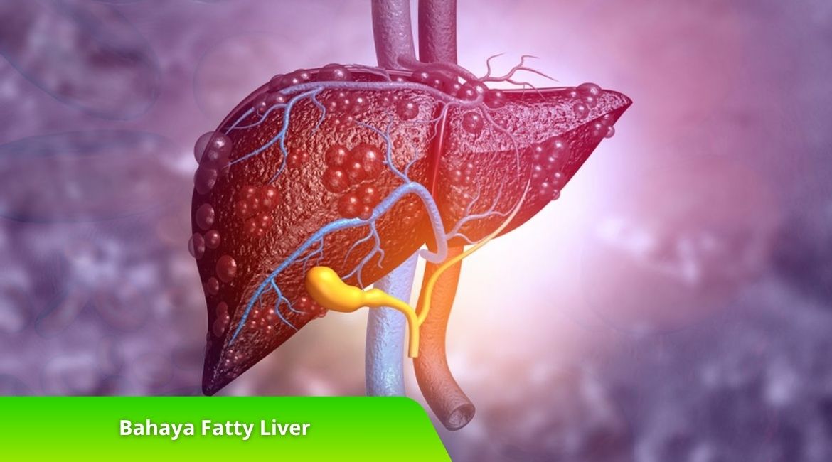 Bahaya Fatty Liver dan Cara Pencegahannya Sejak Dini Bahaya Fatty Liver dan Cara Pencegahannya Sejak Dini