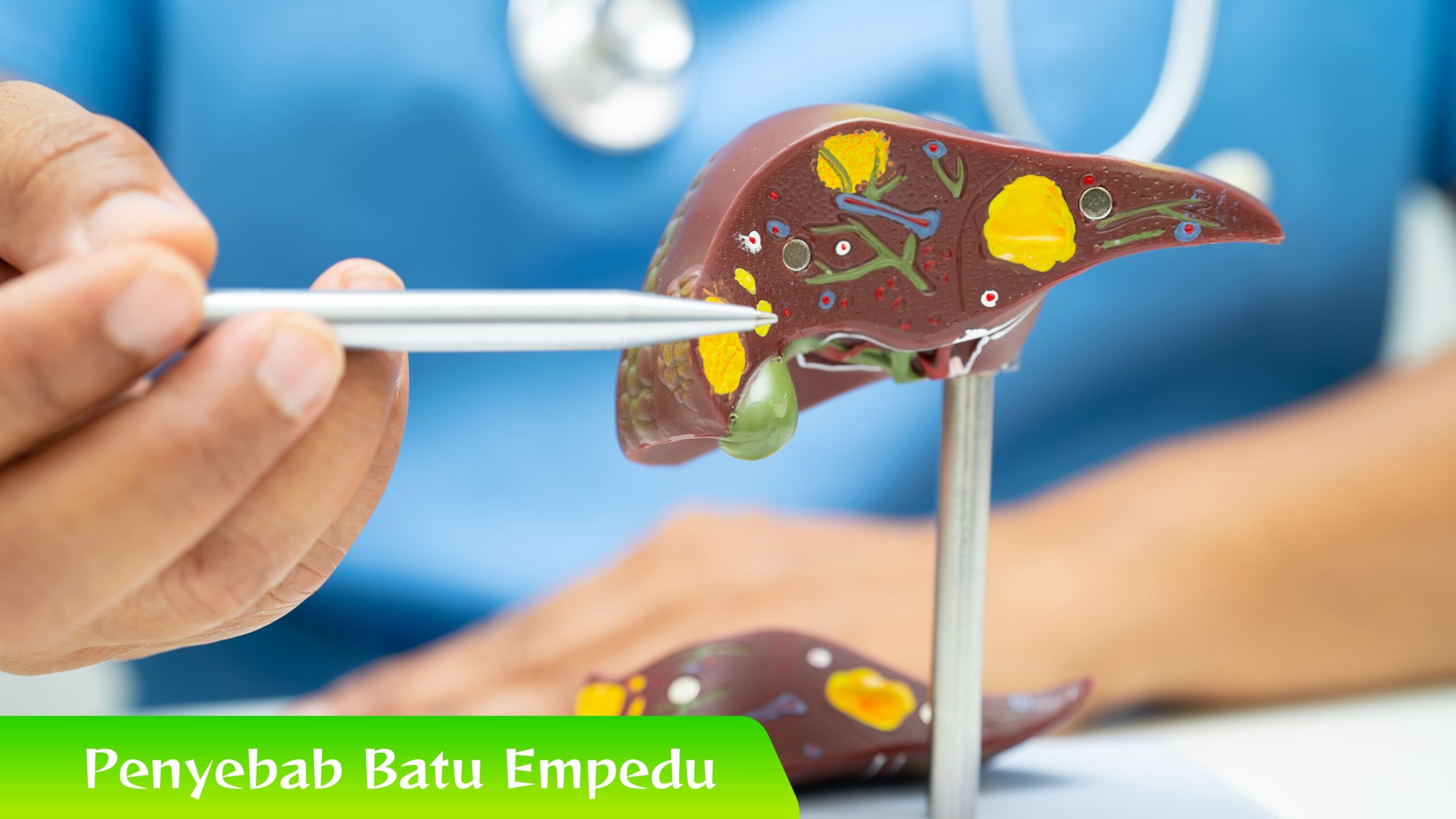 Penyebab Batu Empedu Gak Nyangka! Makanan Sehari-hari Jadi Penyebab Batu Empedu?