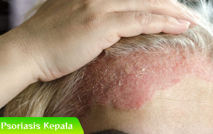 Psoriasis Kepala Bisa Hilang? Ini Faktanya!