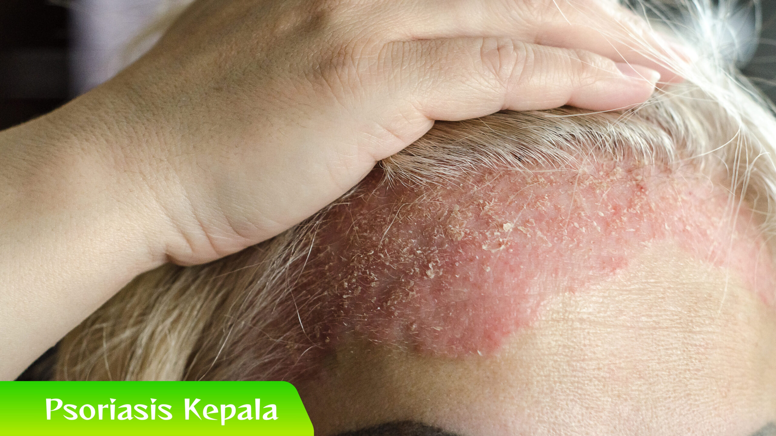 Psoriasis Kepala Psoriasis Kepala Bisa Hilang? Ini Faktanya!