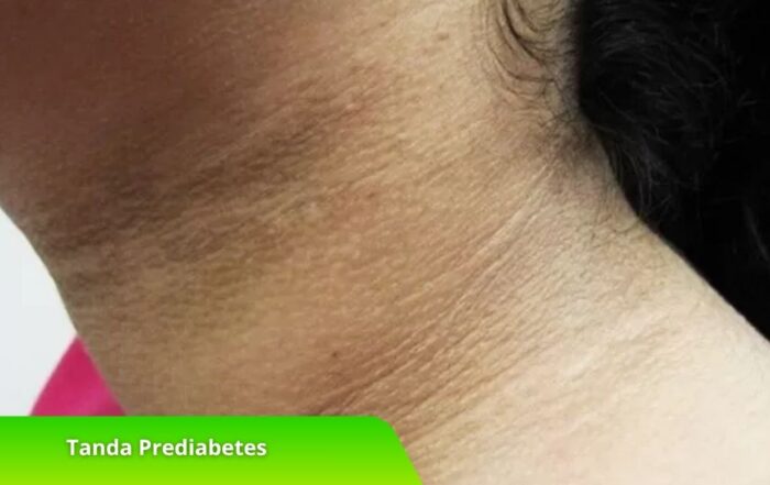 Sederet Tanda Prediabetes dan Cara Mencegahnya, Intip di Sini!