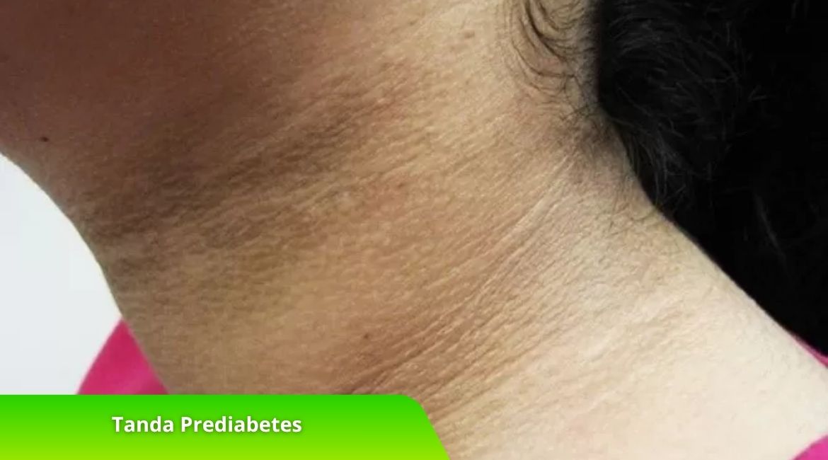 Sederet Tanda Prediabetes dan Cara Mencegahnya, Intip di Sini! Sederet Tanda Prediabetes dan Cara Mencegahnya, Intip di Sini!