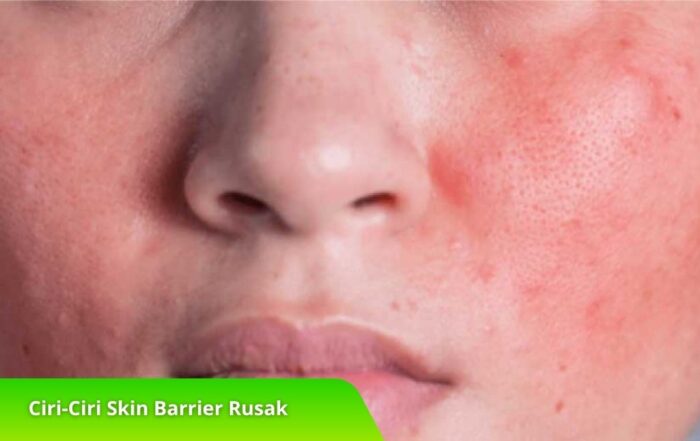 Wajib Tahu! Ciri-Ciri Skin Barrier Rusak dan Cara Mengatasinya