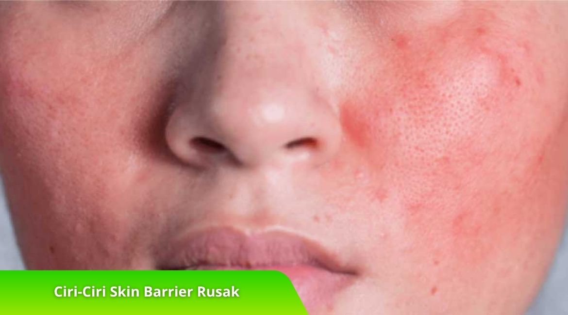 Wajib Tahu! Ciri-Ciri Skin Barrier Rusak dan Cara Mengatasinya