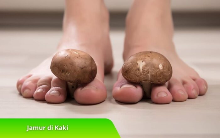Jamur di Kaki? Kenali Ciri-Ciri dan Pengobatan Alaminya di Sini!