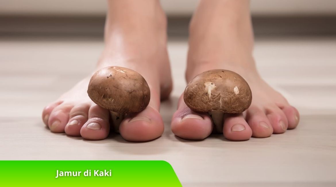 Jamur di Kaki Kenali Ciri-Ciri dan Pengobatan Alaminya di Sini! Jamur di Kaki? Kenali Ciri-Ciri dan Pengobatan Alaminya di Sini!