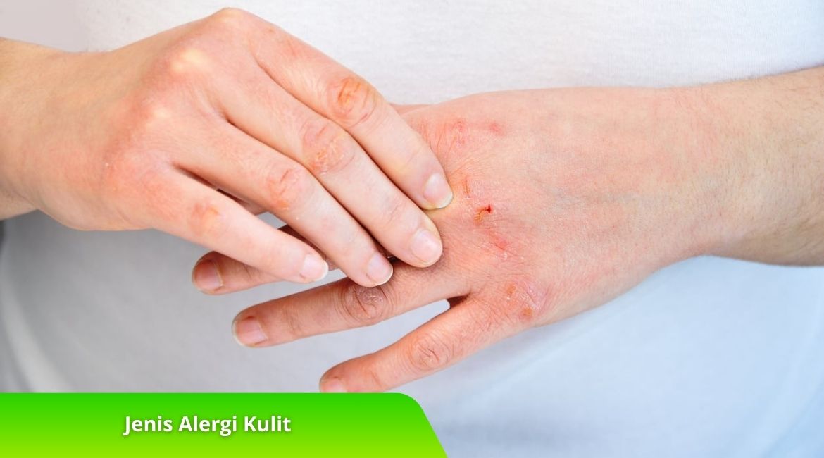 Jenis Alergi Kulit yang Sering Terjadi dan Cara Mengatasinya