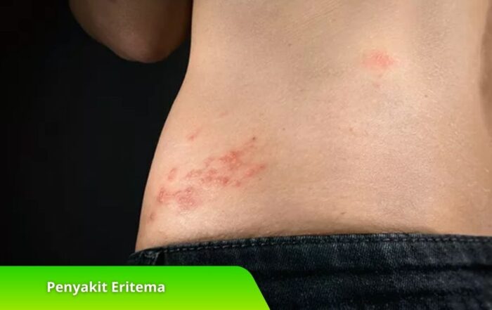 Mengenal Penyakit Eritema, Kelainan Kulit yang Wajib Diwaspadai