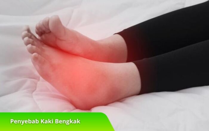 Penyebab Kaki Bengkak yang Perlu Anda Ketahui Sebelum Terlambat