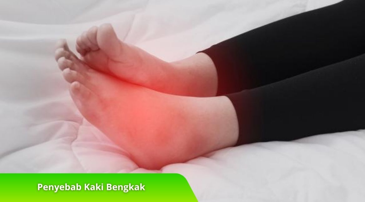 Penyebab Kaki Bengkak yang Perlu Anda Ketahui Sebelum Terlambat Penyebab Kaki Bengkak yang Perlu Anda Ketahui Sebelum Terlambat