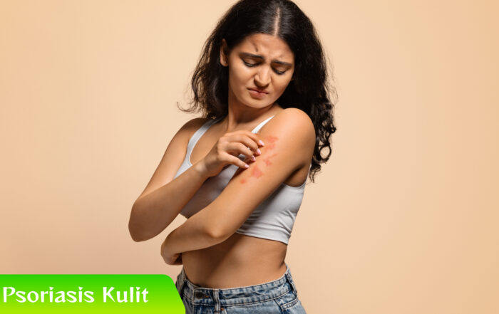 Kenali Gejala Psoriasis Kulit Sebelum Terlambat