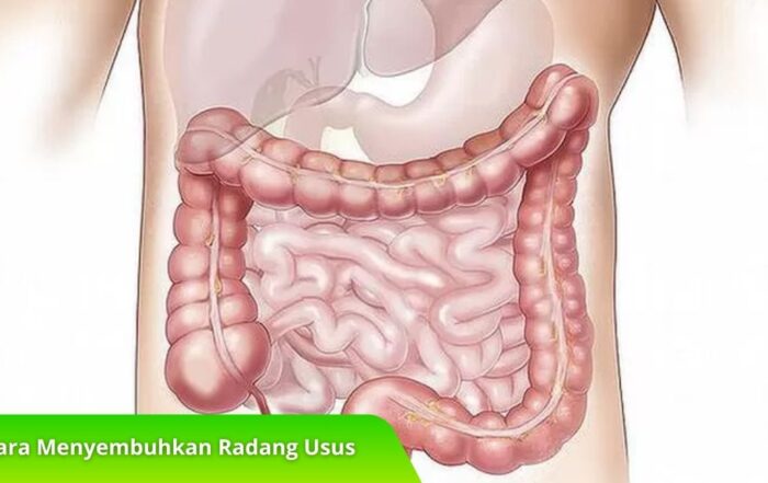 Rahasia Cara Menyembuhkan Radang Usus Tanpa Efek Samping