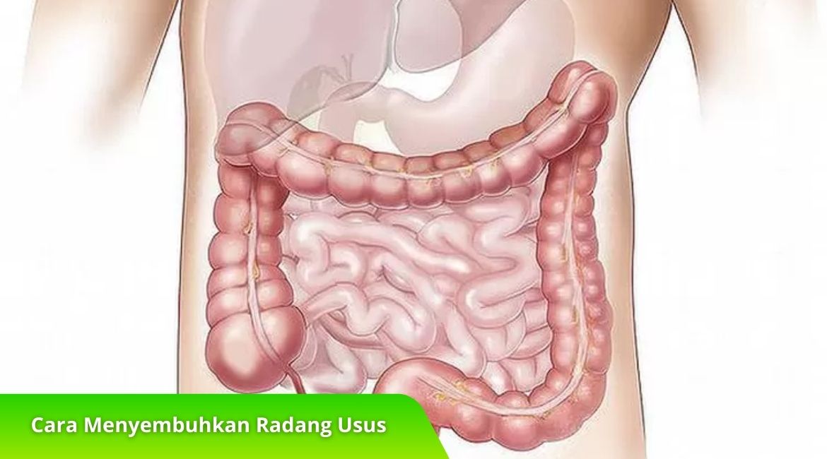 Rahasia Cara Menyembuhkan Radang Usus Tanpa Efek Samping