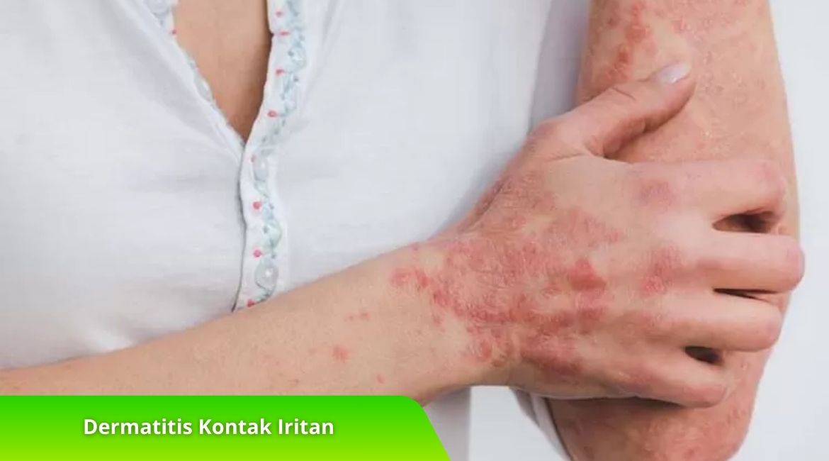 Bedanya Dermatitis Kontak Iritan dan Alergi, Jangan Keliru! Bedanya Dermatitis Kontak Iritan dan Alergi, Jangan Keliru!